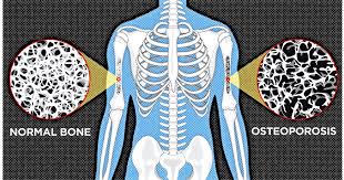 Calcium in Osteoporosis