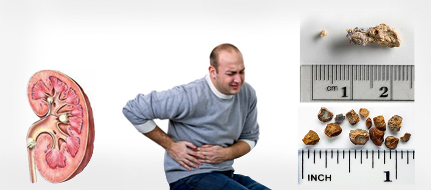 Dietary Advice for Kidney Stone Disease