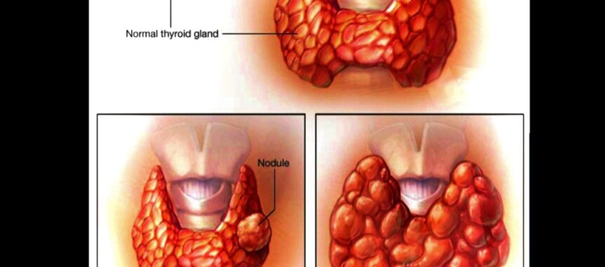 HEALTHY EATING FOR THYROID NODULES